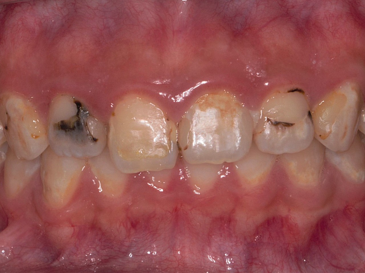 术前诊断上前牙多颗龋坏,补牙后仍发黑方案设计上