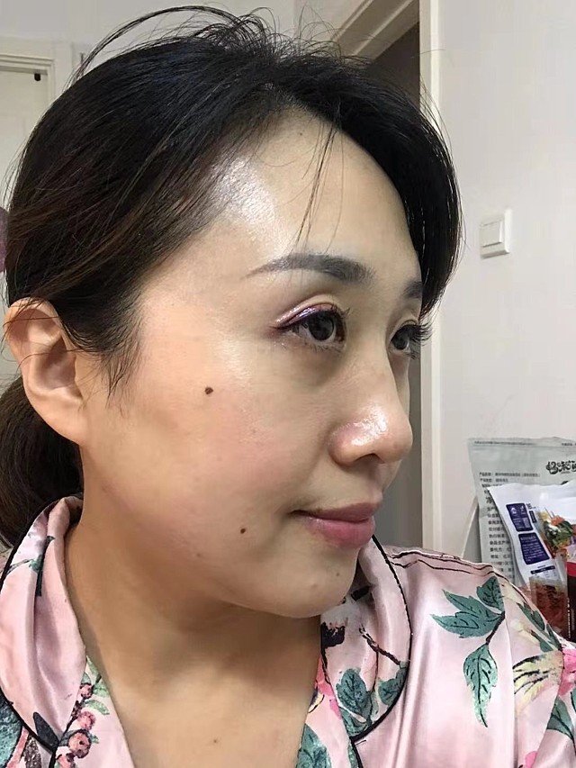 今天术后第10天,眼袋恢复的很好,我朋友见了还夸我_圈子-新氧美容整形