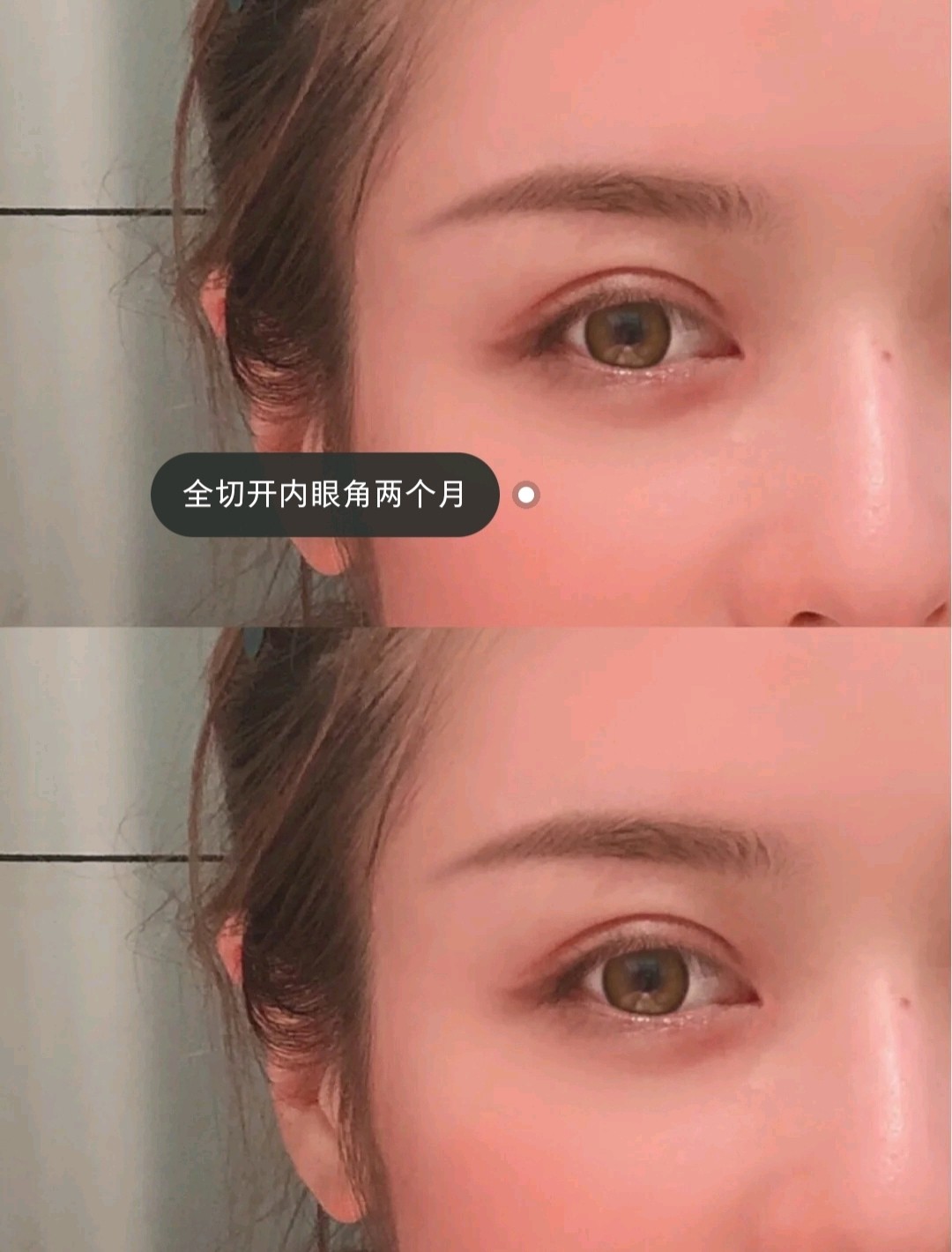 上睑下垂矫正和眼尾提升效果一样吗?