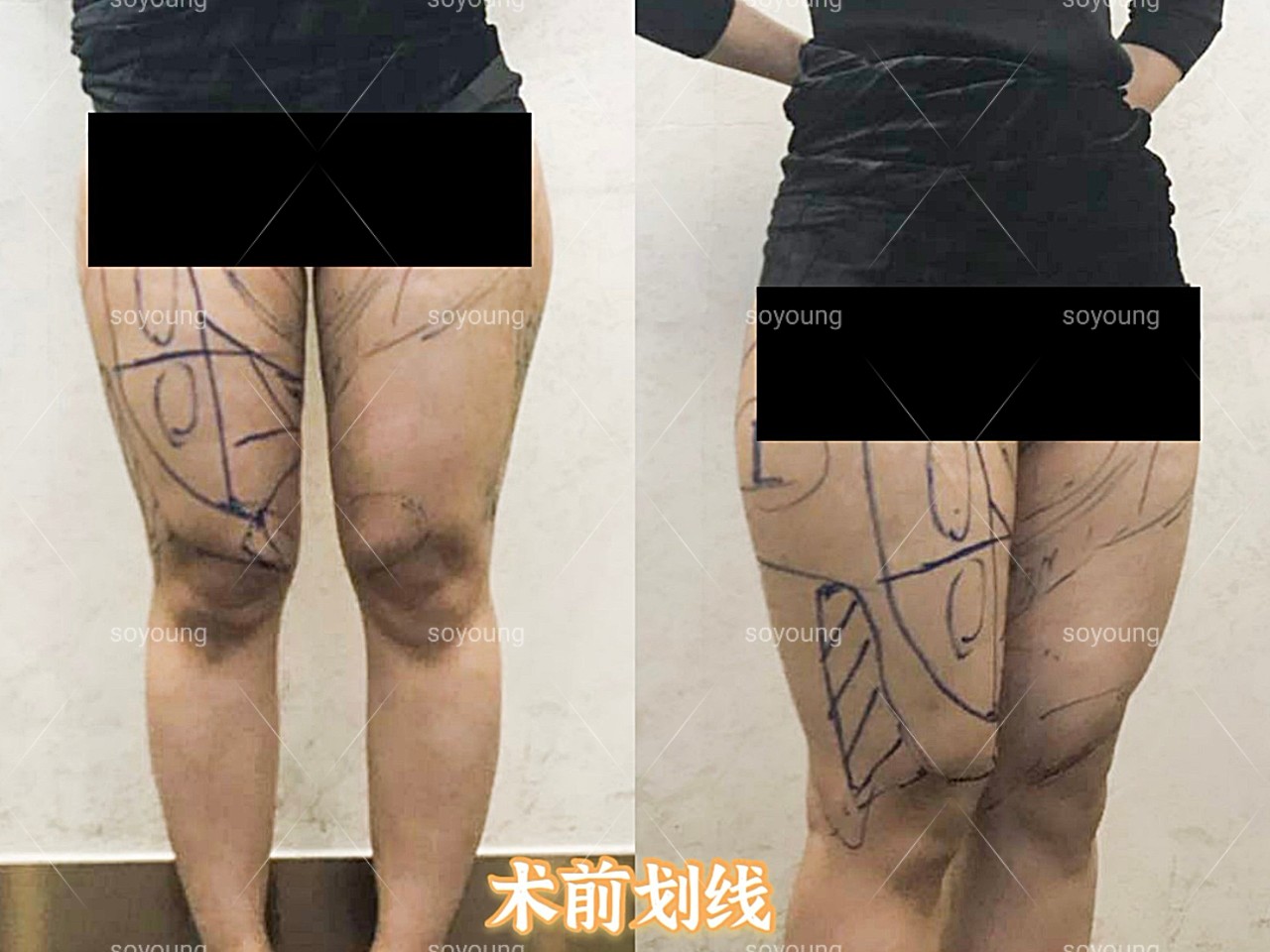 求美者是典型的梨形身材,上半身纤细,脂肪主要堆积在臀部和大腿处