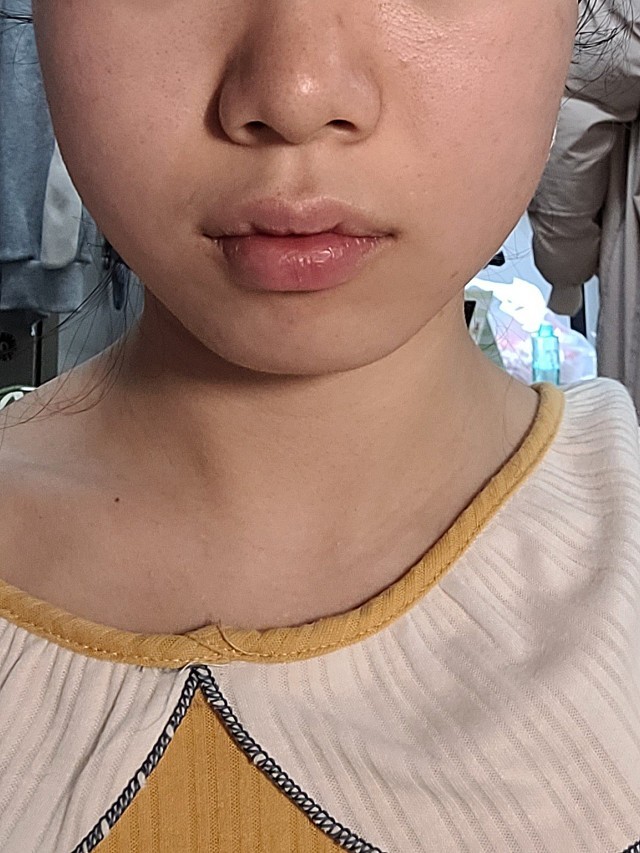 刚打完之后脸有些浮肿,肿和消肿没有对比性.