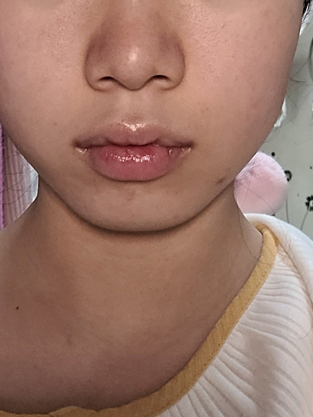 刚打完之后脸有些浮肿,肿和消肿没有对比性.