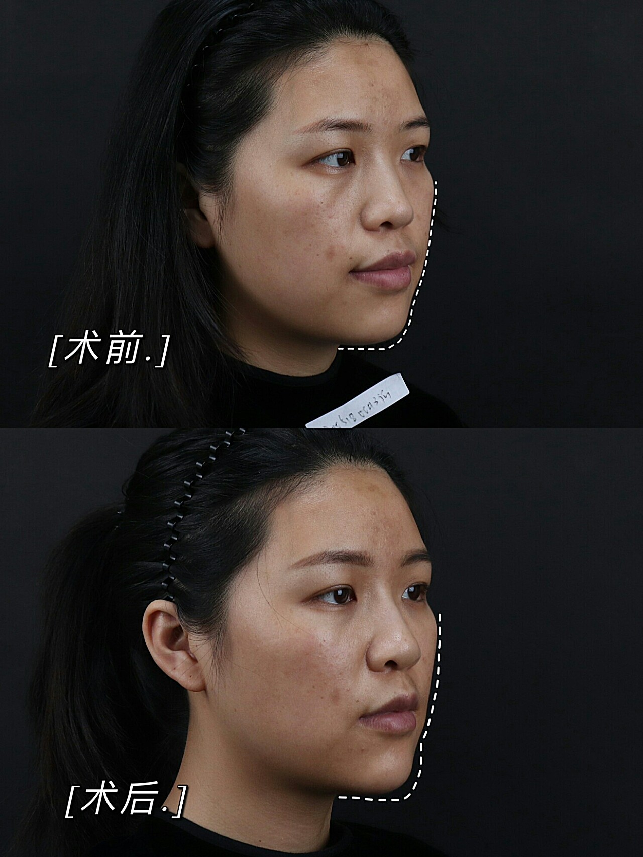 术前诊断术前下巴短平,太阳穴面颊凹陷,苹果肌额头扁_圈子-新氧美容