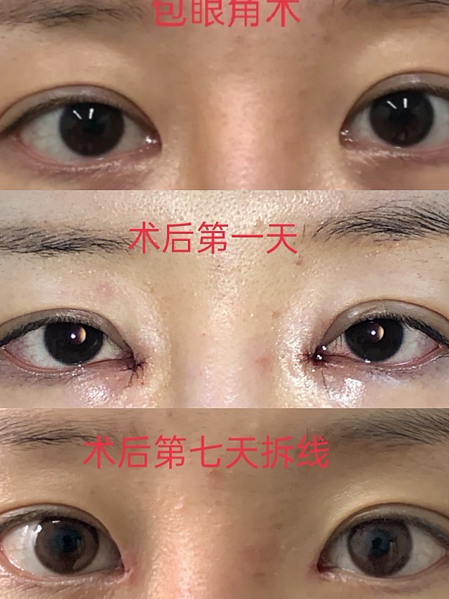 内眼角开大了,显老气,找院长包眼角,自然又适合自己_圈子-新氧美容