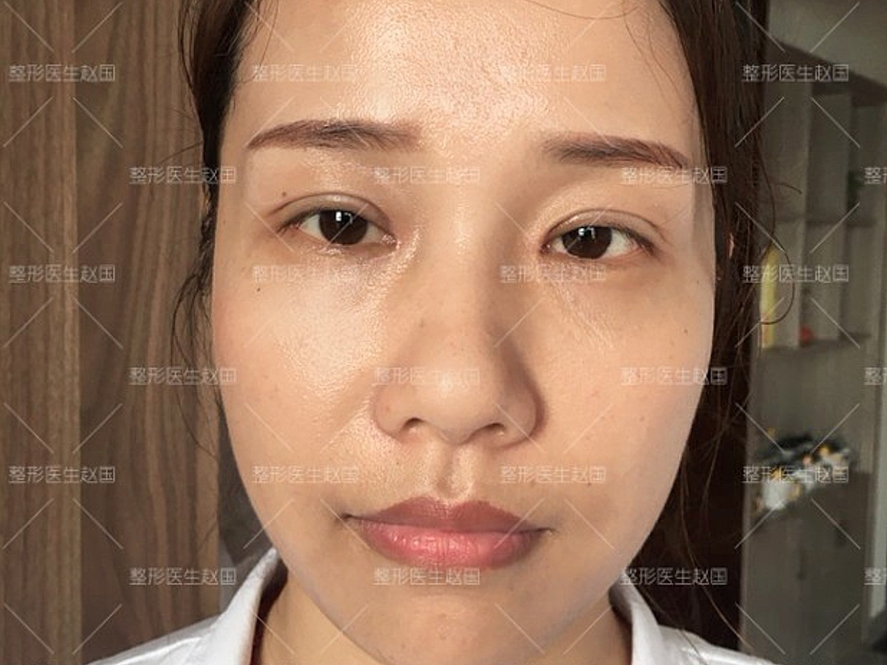 【女性在35岁以后普遍都会出现眼尾下垂】,眼睑皮肤_圈子-新氧美容