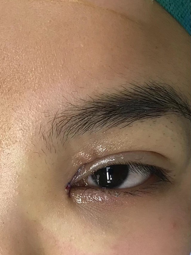 眼球内大肿物从双眼皮切口进入完整取出无痕微创_圈子-新氧美容整形