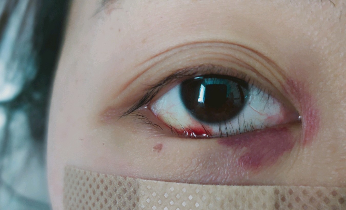 做完内切眼袋下睫毛倒睫