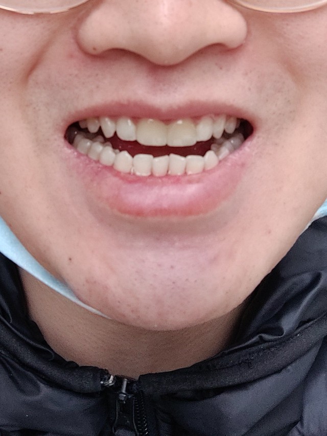 体验前变美诉求:把中间门牙的缝搞好