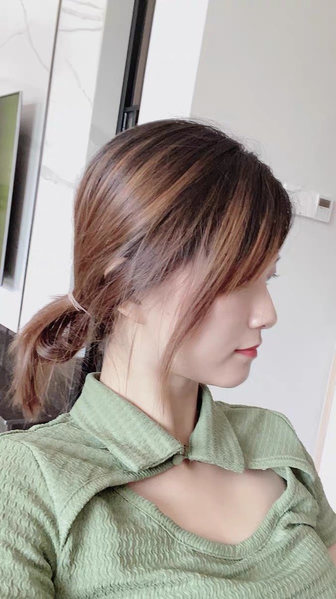 我没有做面部吸脂手术之前,侧脸是不可能侧脸的,下颌_圈子-新氧美容