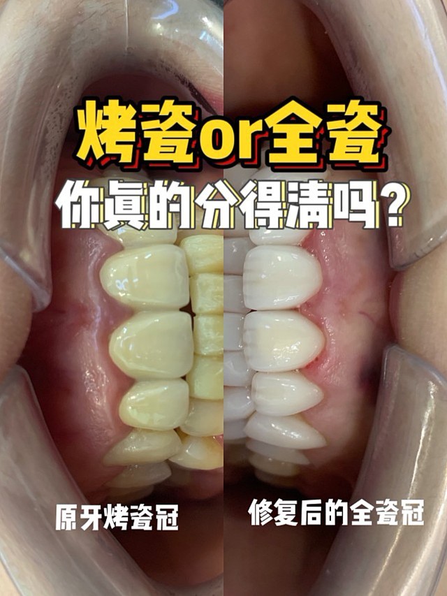 首先搞清楚烤瓷牙和全瓷牙的区别!