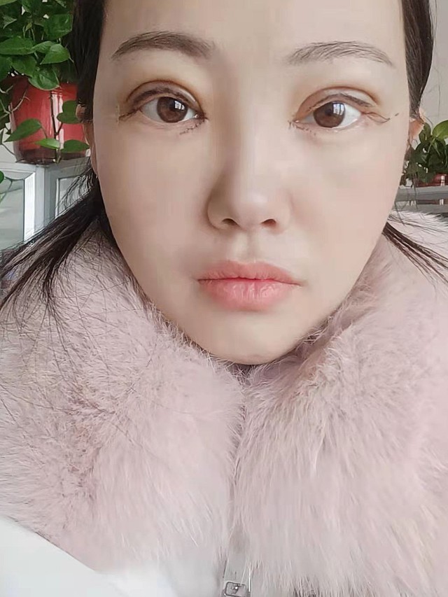 割完双眼皮的第2天,没有人帮我拍照片,只能自己给自_圈子-新氧美容