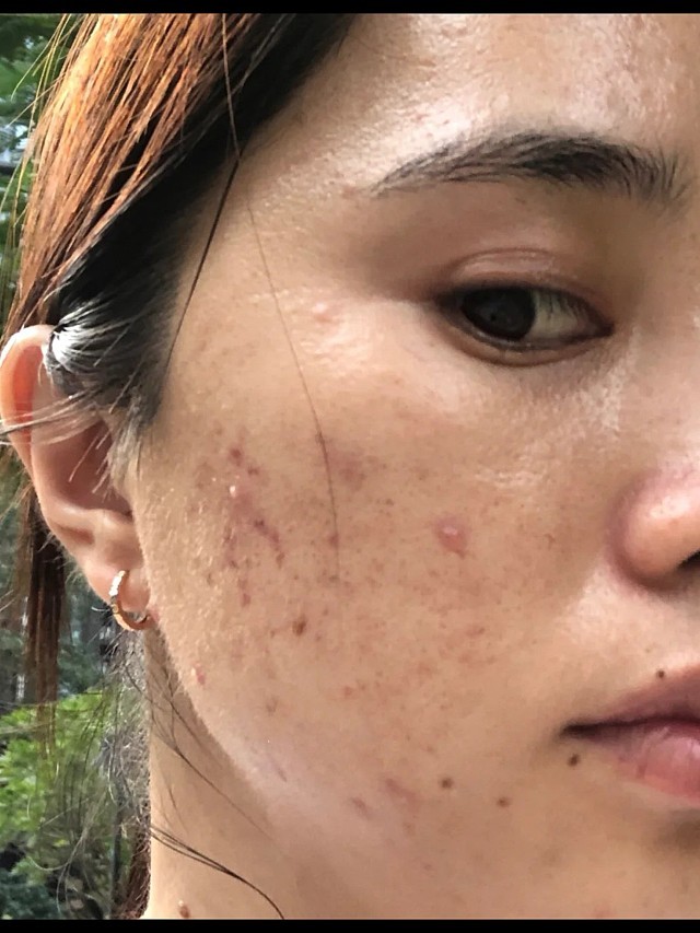 体验前变美诉求:青春时长了很多痘痘,经常拿手抠他,造成现在留下坑坑