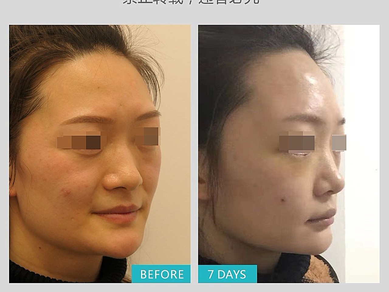 用玻尿酸填充完鼻基底后,效果立竿见影,心里很高兴,但是医生告诉我,还