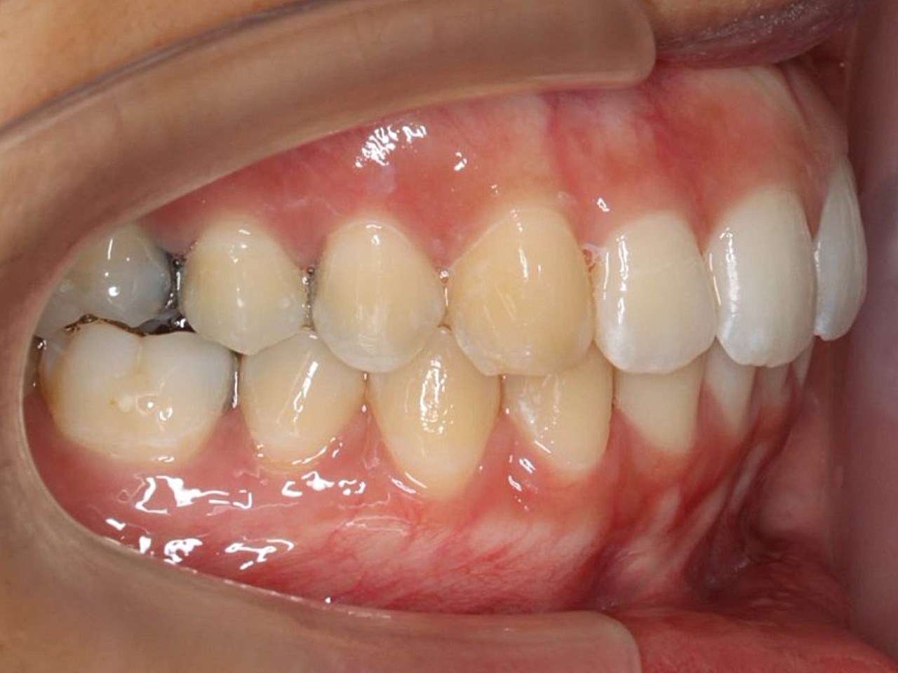 术前诊断内收前牙矫正牙齿案例这是一位下颌后缩的患者_圈子-新氧美容