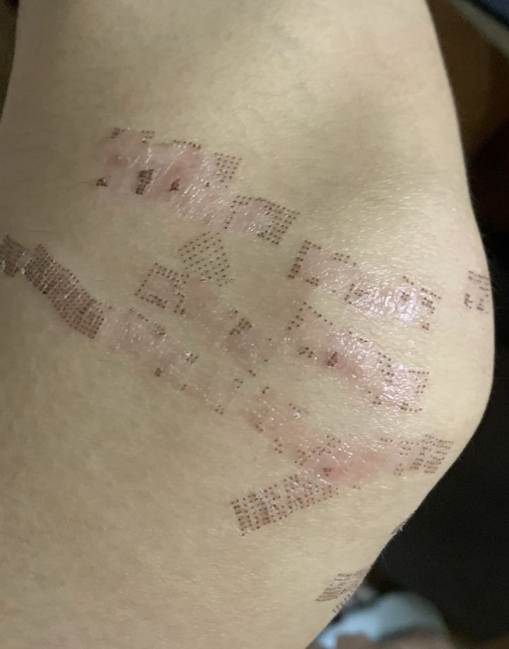 青春期长了很多生长纹,特别难看,网上看到这家医院,_圈子-新氧美容