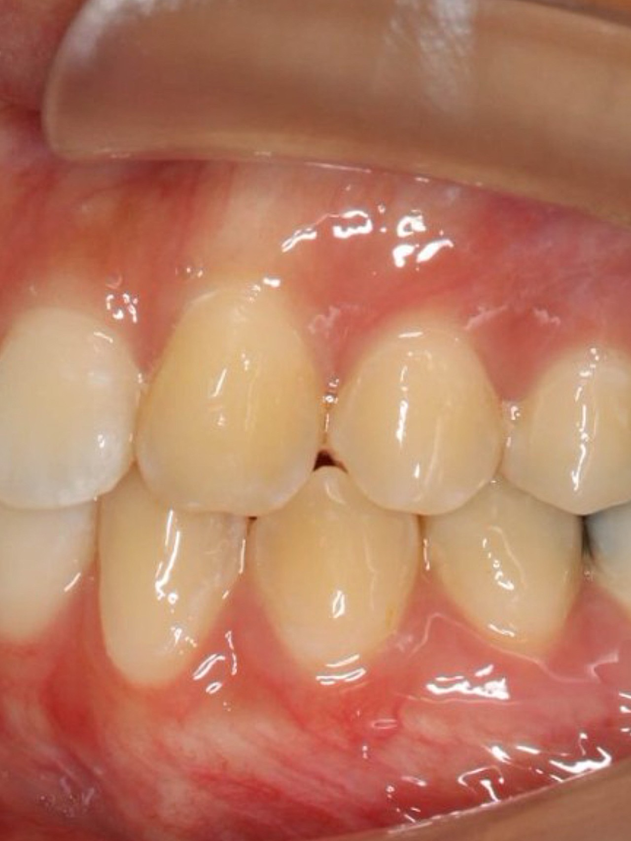 术前诊断内收前牙矫正牙齿案例这是一位下颌后缩的患者_圈子-新氧美容