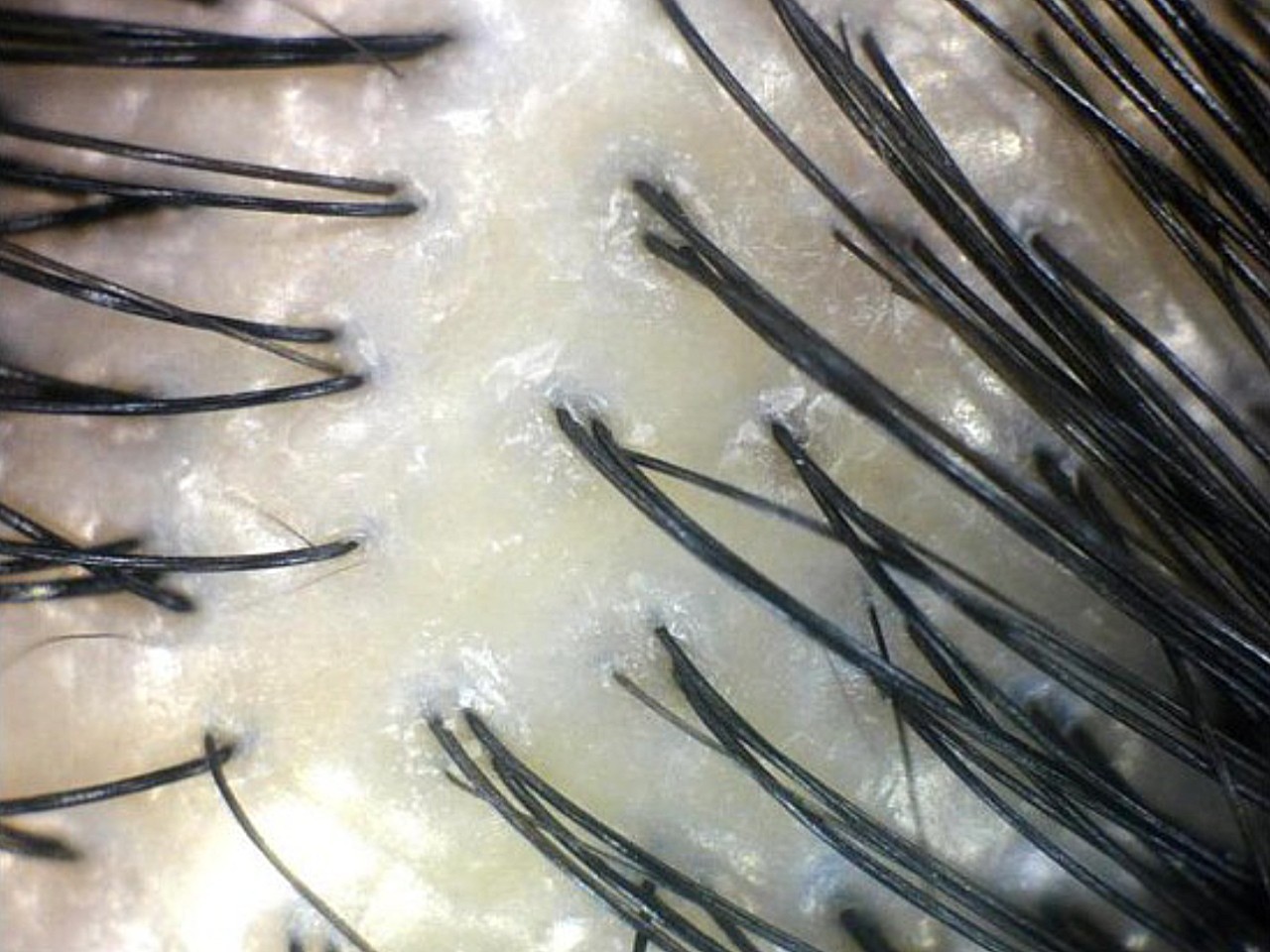 图一二为干性头皮治疗前后