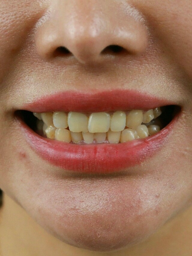 我是之前在这做的矫正排齐牙齿,现在牙齿是很整齐了,_圈子-新氧美容