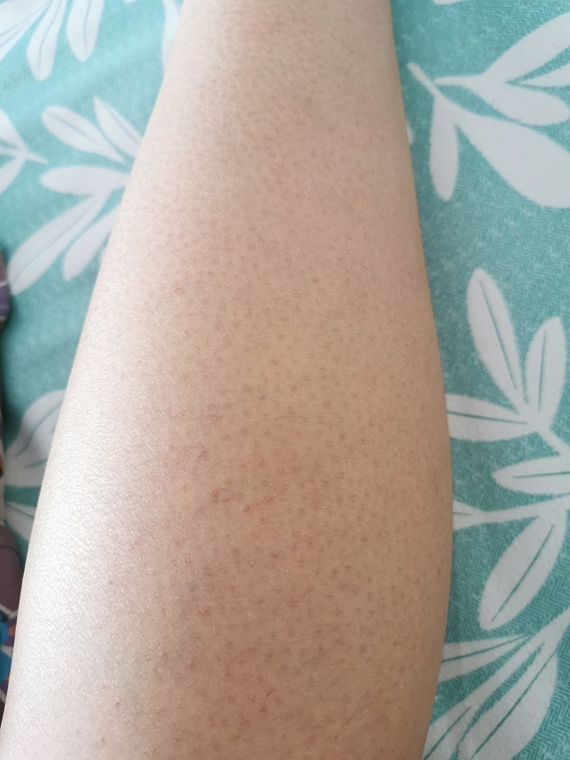 鸡皮肤怎么突然越来越多(鸡皮肤怎么突然越来越多了)
