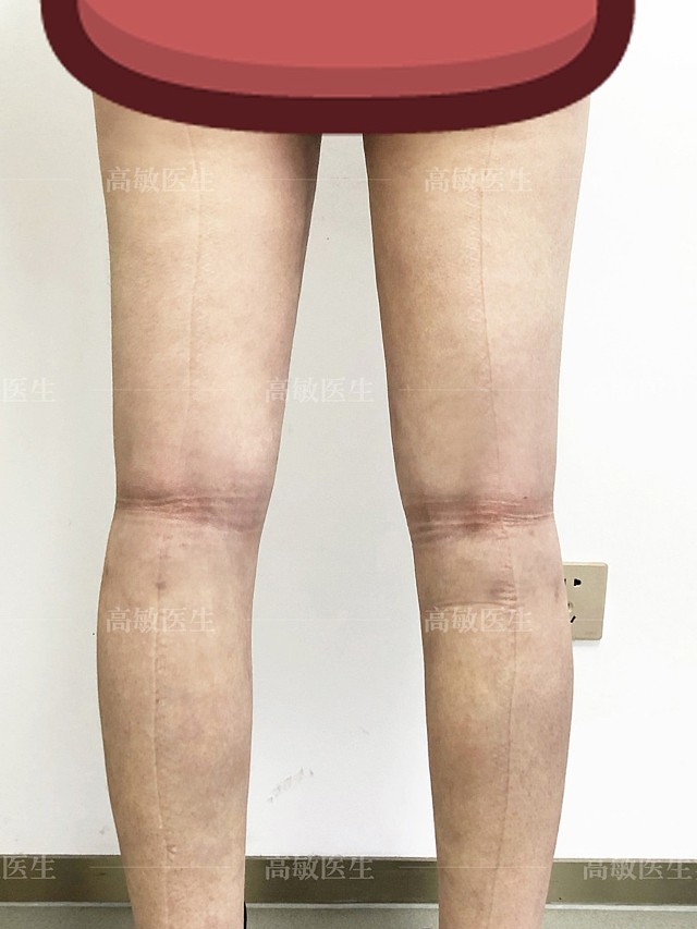 大腿脂肪萎缩图片图片