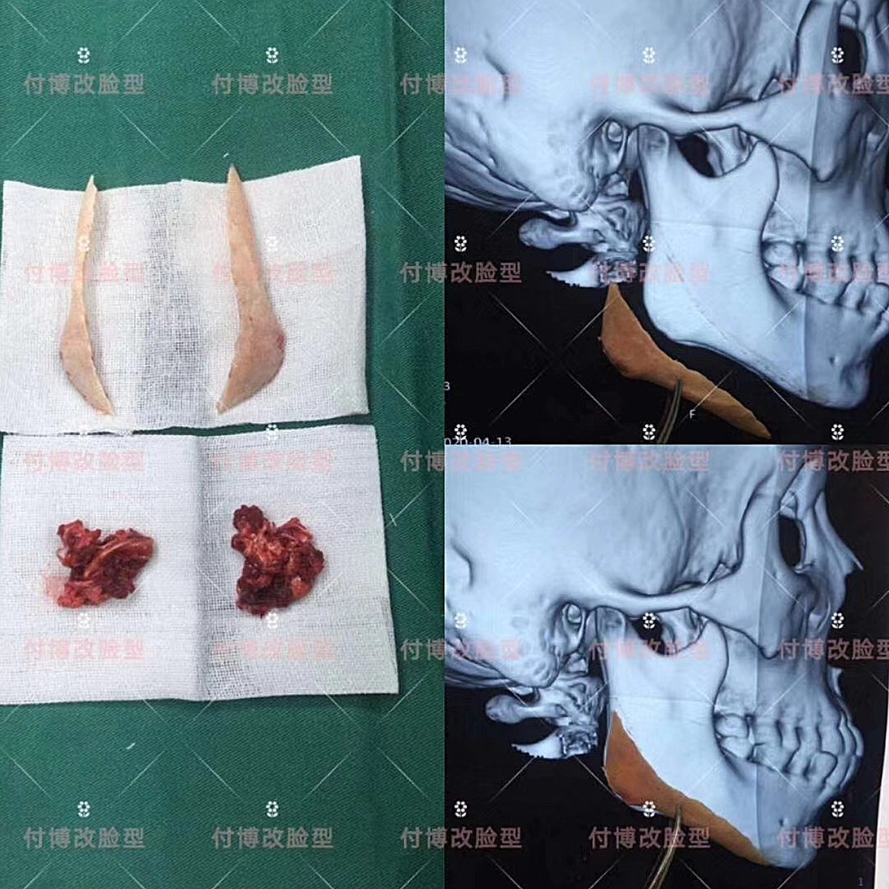 【下颌角超长曲线截骨 咬肌】付博