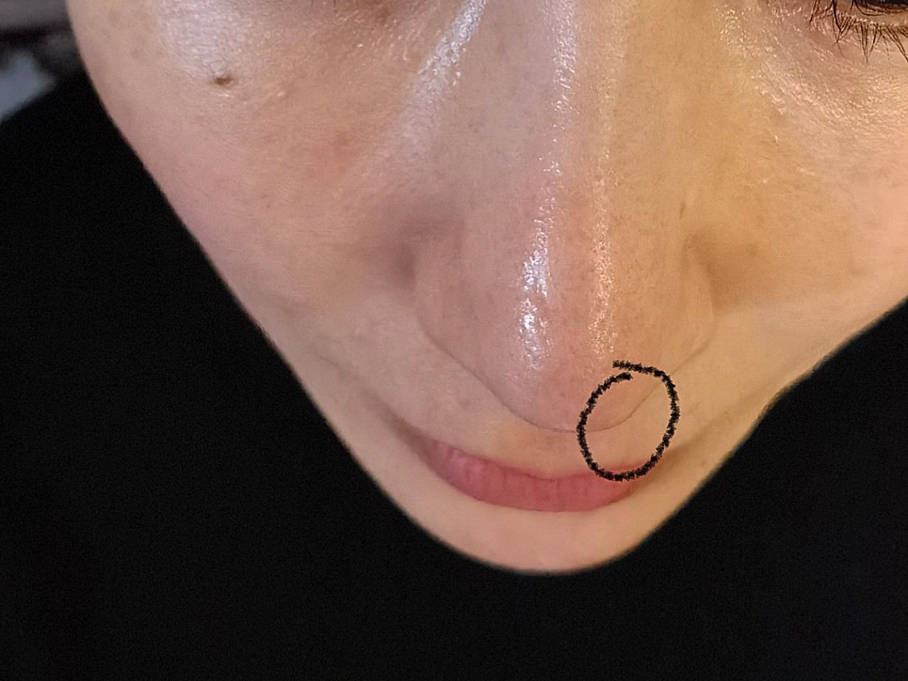 自体耳软骨垫鼻尖,术后四个月多鼻尖左侧有个白色的凸
