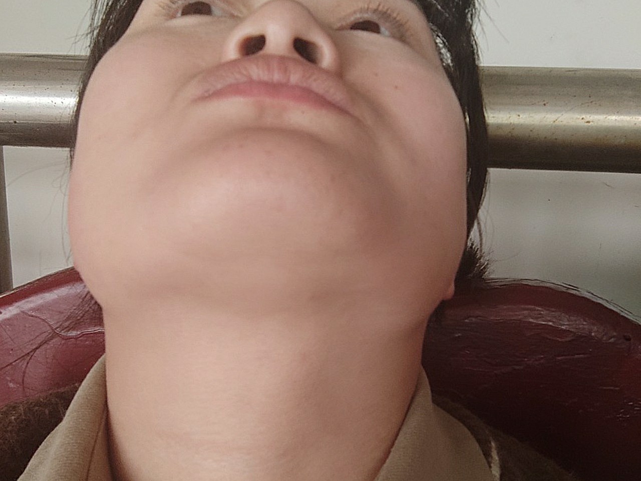 新氧公益救助招募塌鼻子,严重的面中部凹陷.