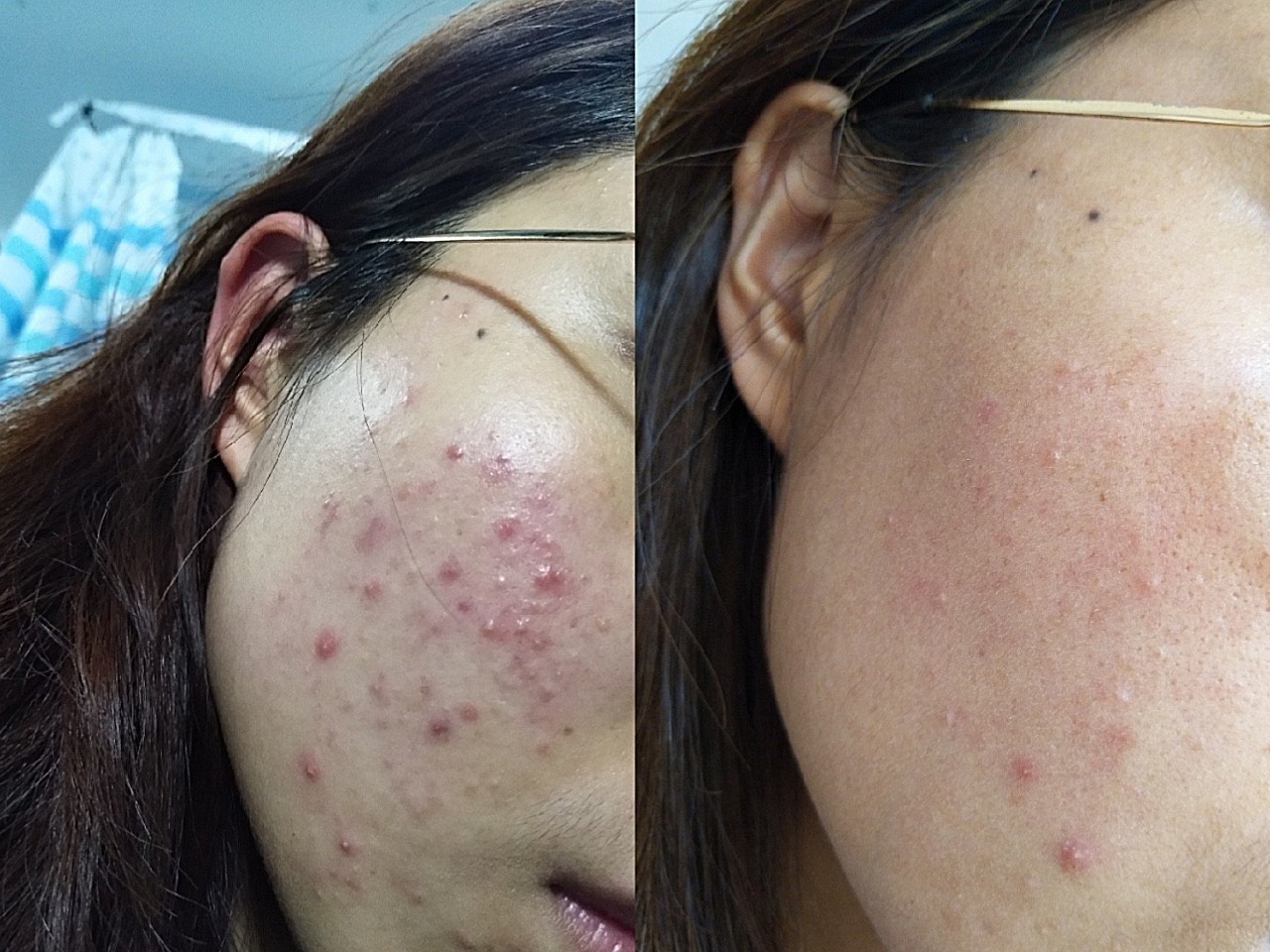 通过针清痘痘的方式,及时释放毛囊皮脂腺内的炎性分泌_圈子-新氧美容