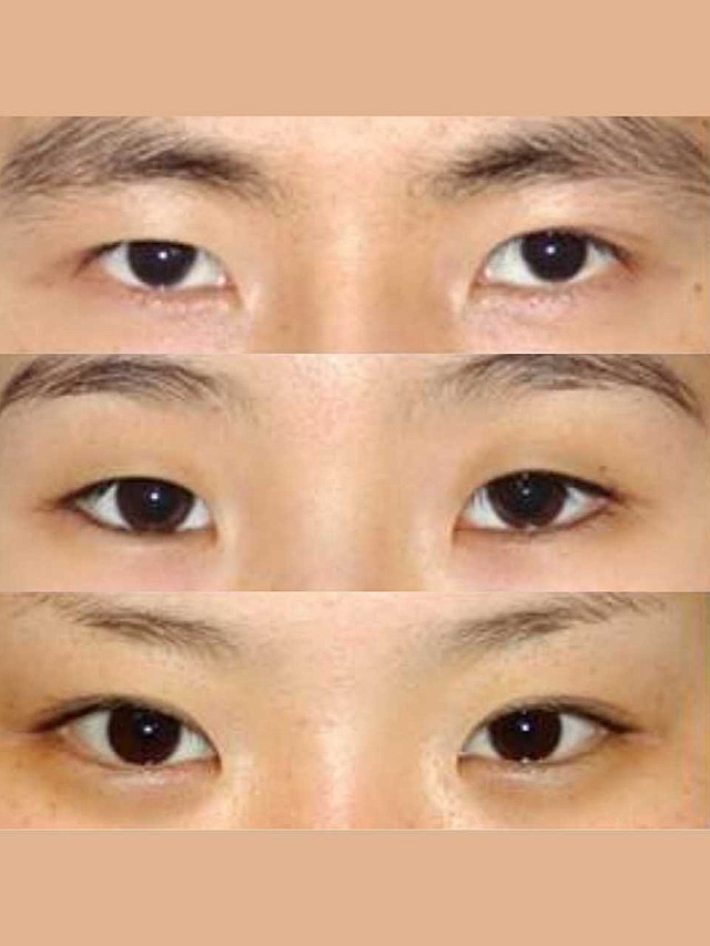 眼裂短小者:眼睛看上去短小,开外眼角能增加眼睛长度_圈子-新氧美容