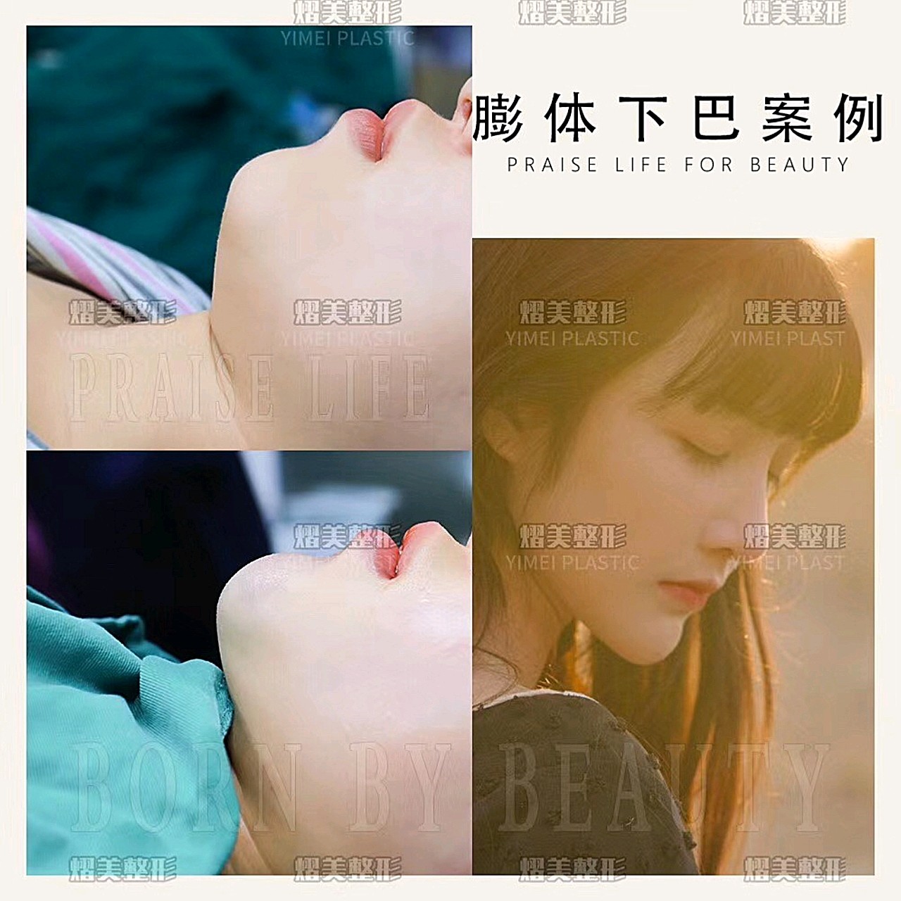 半年前做了膨体垫下巴对比曾经变化真