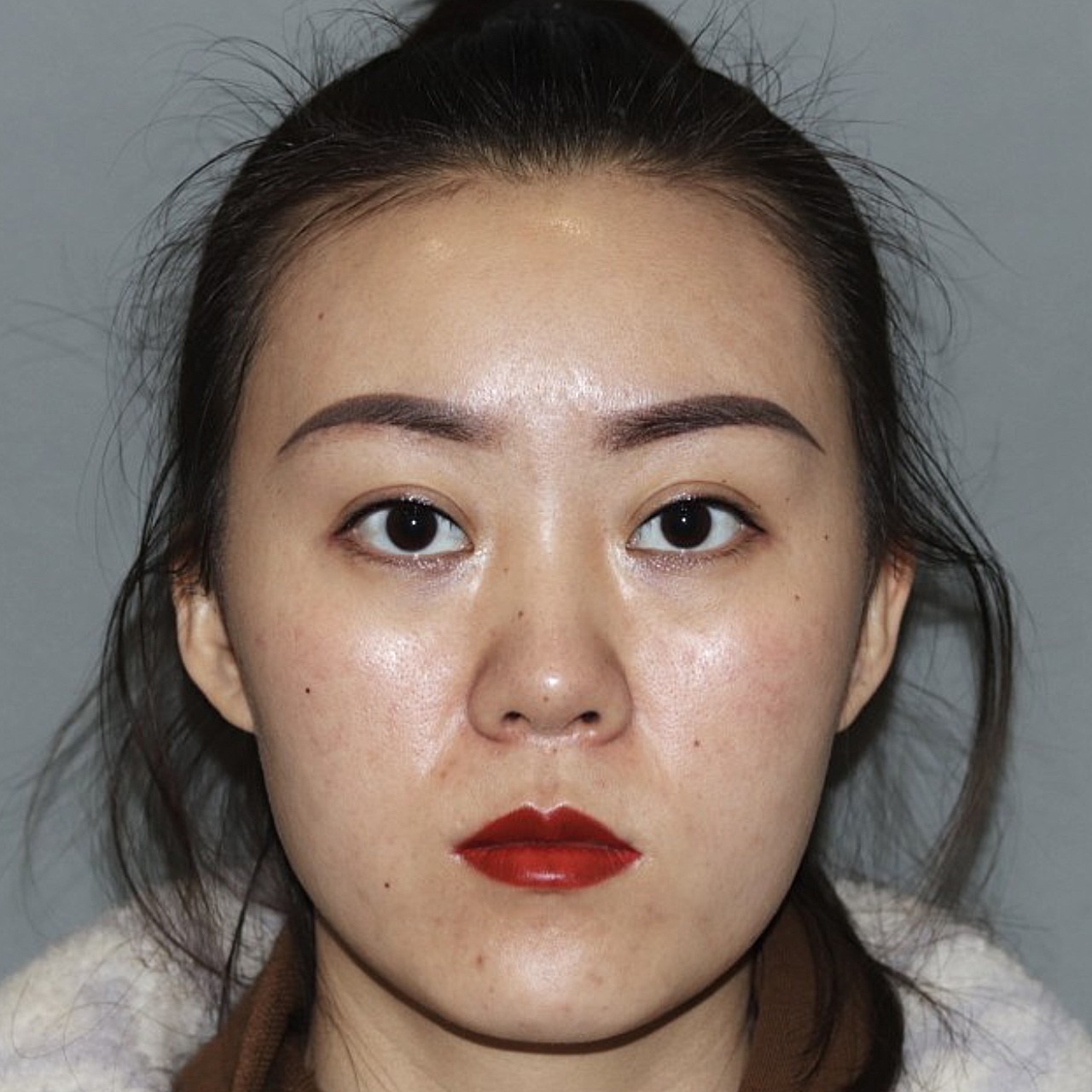 术前诊断看起来是短鼻子,实际上却是长中庭(长度约7_圈子-新氧美容