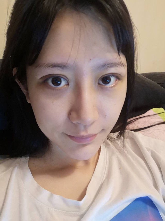 在做项目前:我之前的双眼皮不是很明显,特别窄,如果_圈子-新氧美容