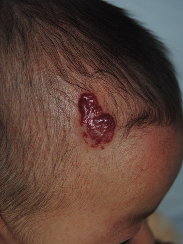 头皮血管瘤初期图片