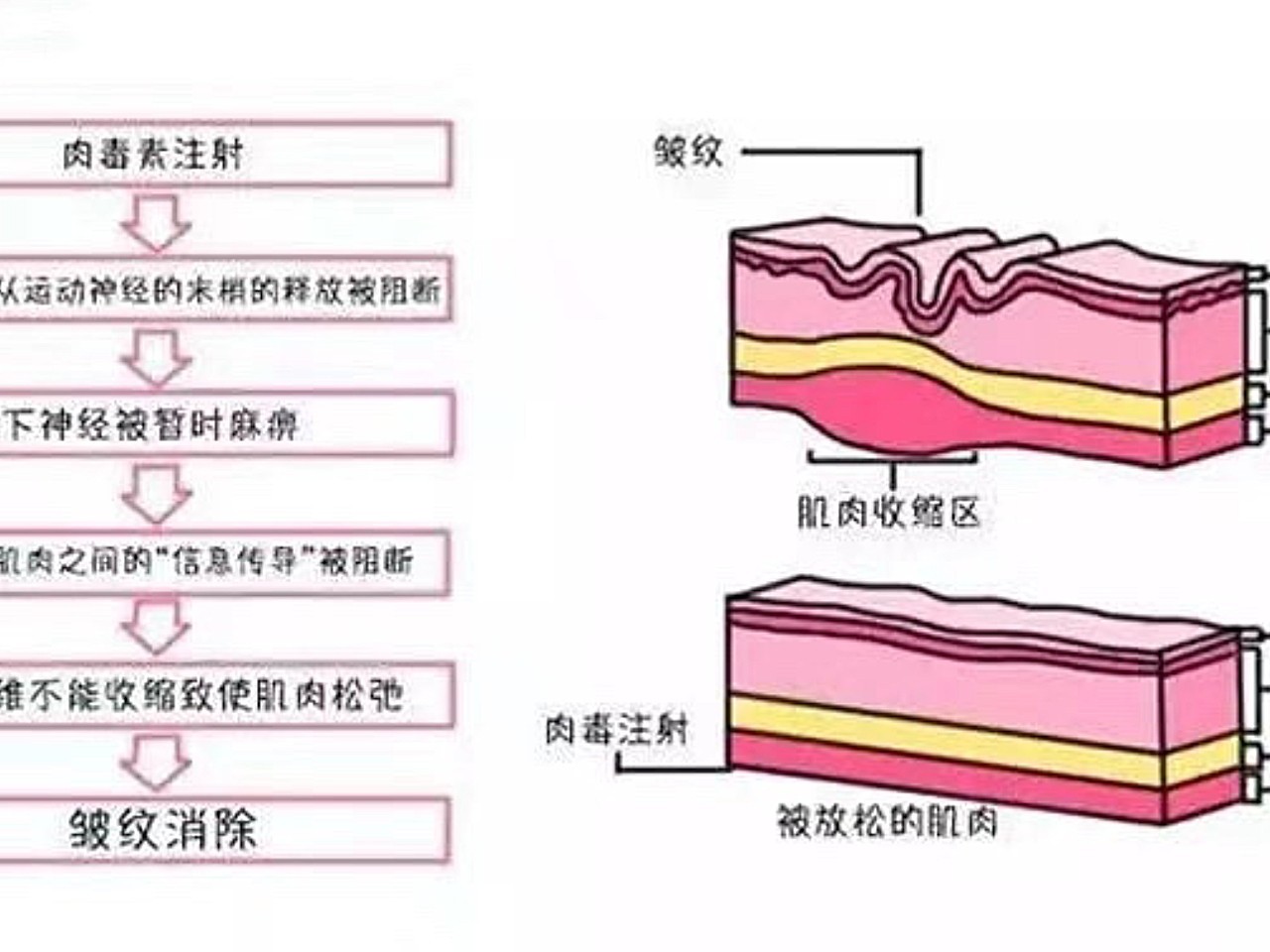 打完除皺針後面部僵硬老的快?謊言揭穿過程