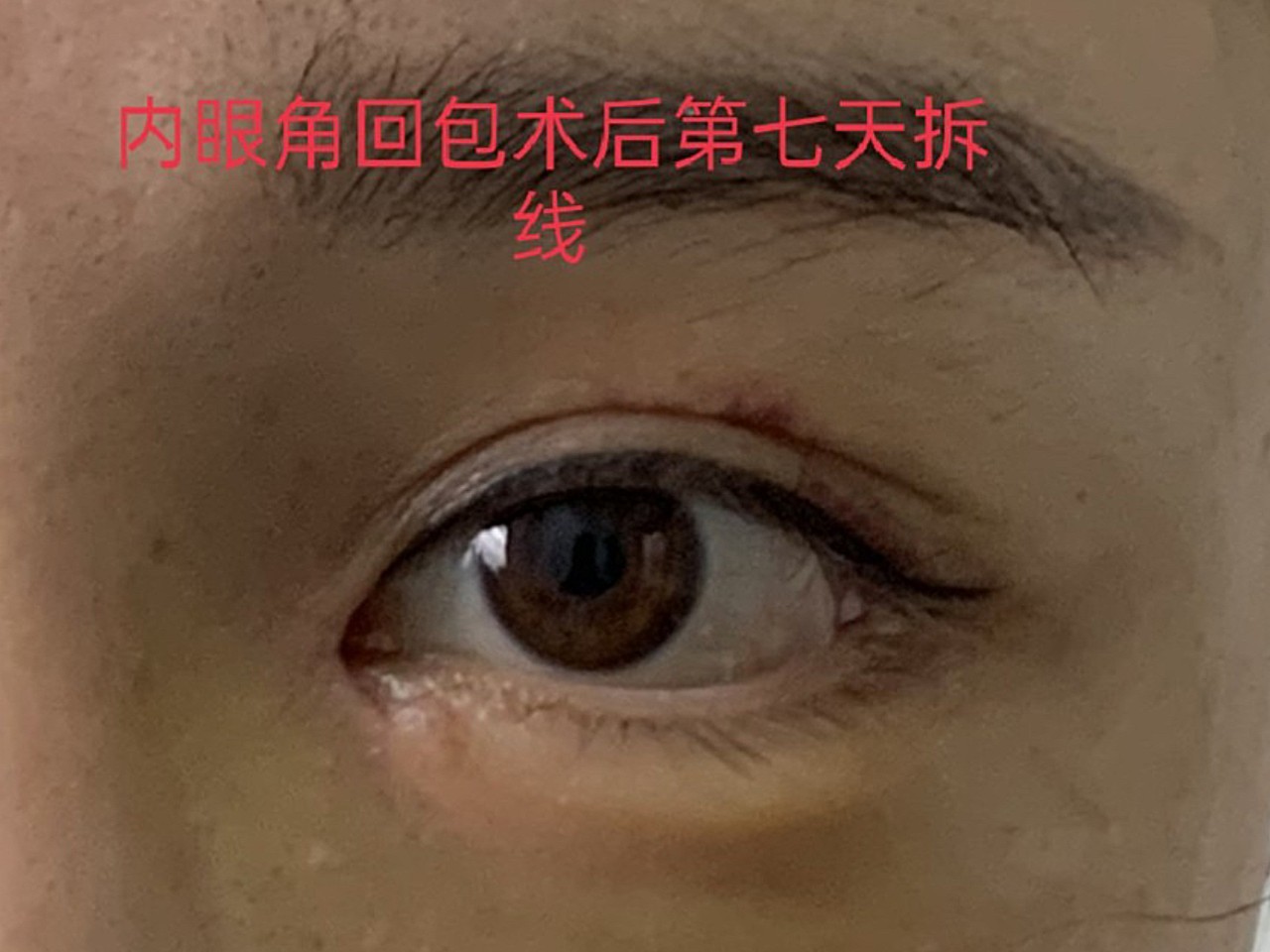 内眼角开大了,眼睛是好看了,后期露红肉就不太美光哦_圈子-新氧美容