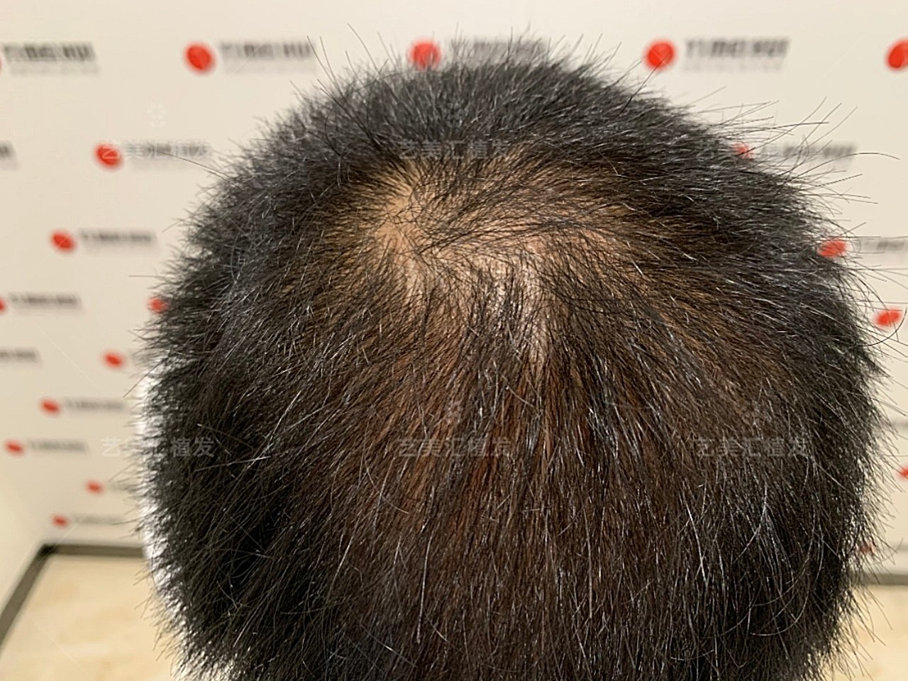 根据求美者诉求,设计形状,画线植发区域,根据头顶脱发面积测量种植