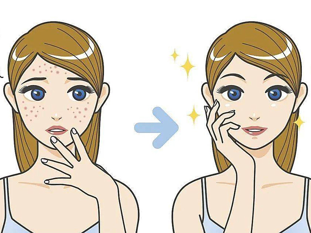 教你简单几招,远离痘痘烦恼!