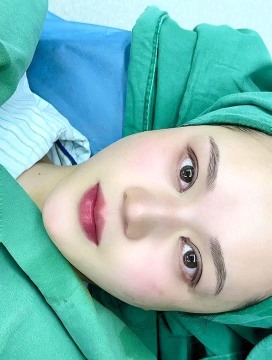 全切双眼皮术后即刻