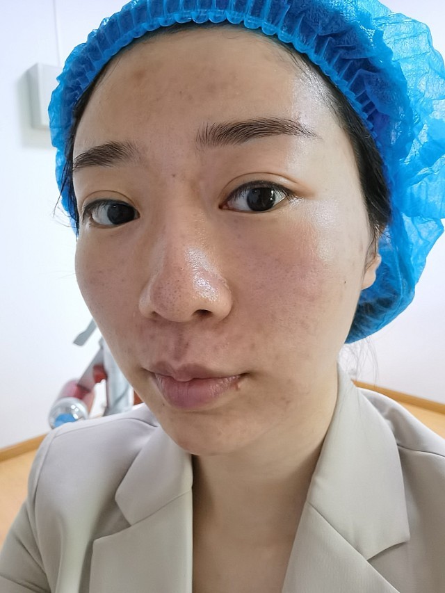 选了非剥脱点阵激光.目前没有什么感觉,看_圈子-新氧美容整形