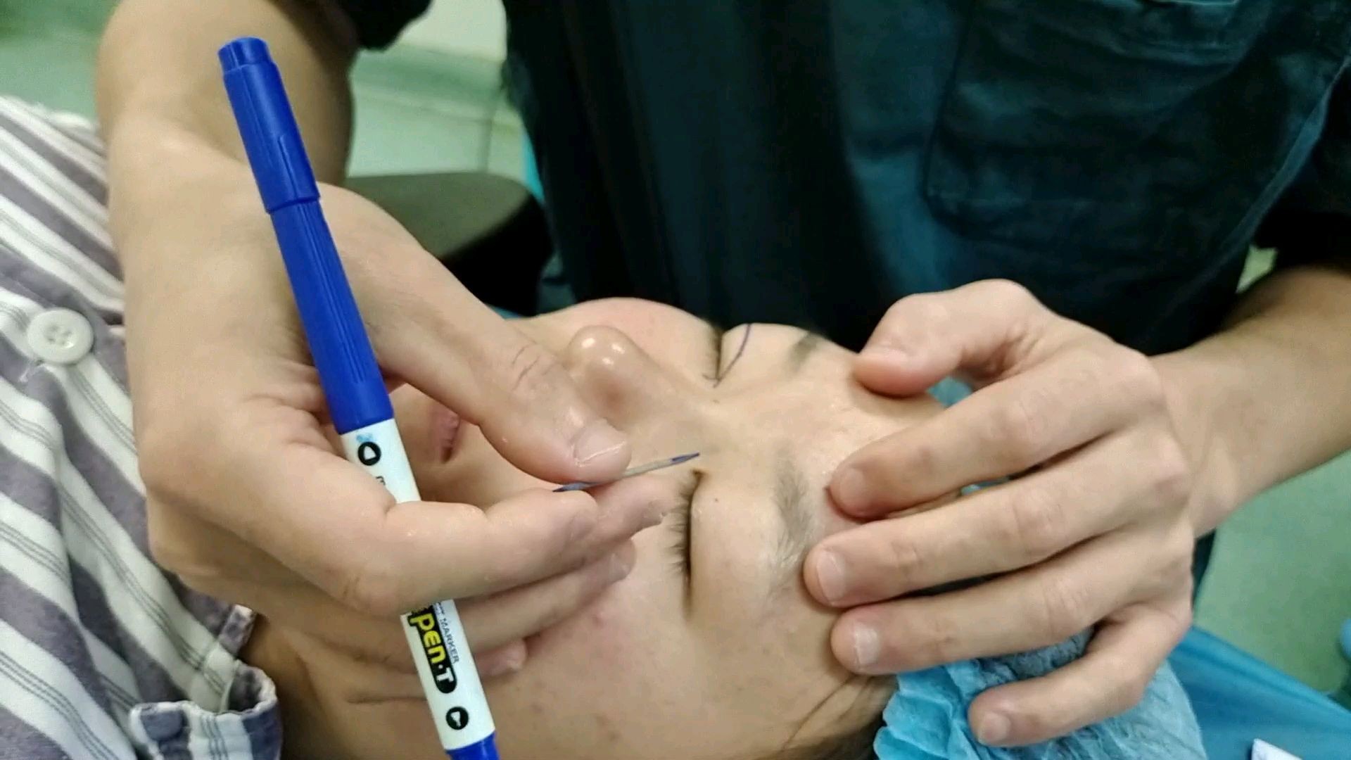 双眼皮手术设计画线中,需要这样来来回回,反反复复测_圈子-新氧美容