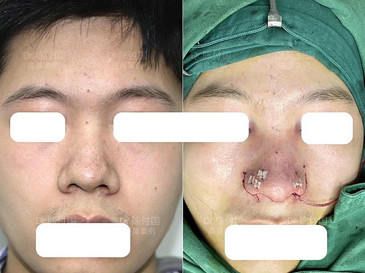 全肋软骨鼻部多项术后5个月