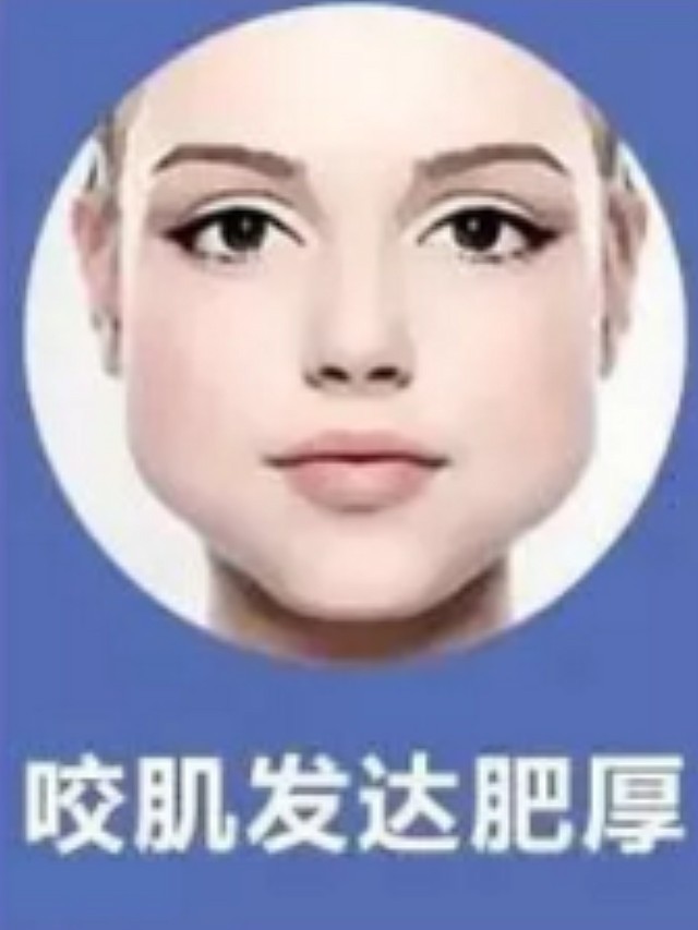 面部骨骼发育宽大:面部骨骼结构不匀称,下颌角过分外翻,颧骨外扩明显