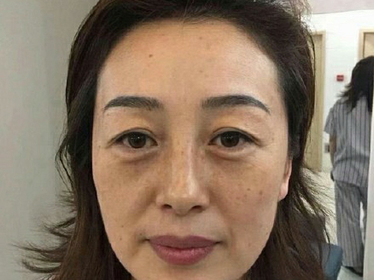 而且我的八字脸也是日渐明显,左右脸感觉还是不对称的,年纪不大就开始