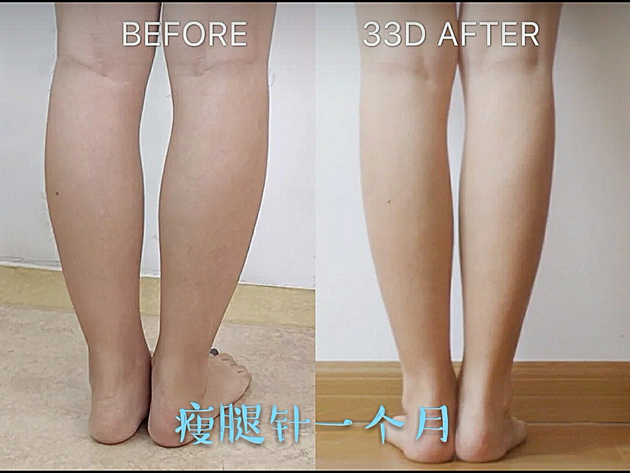 瘦腿针科普来啦