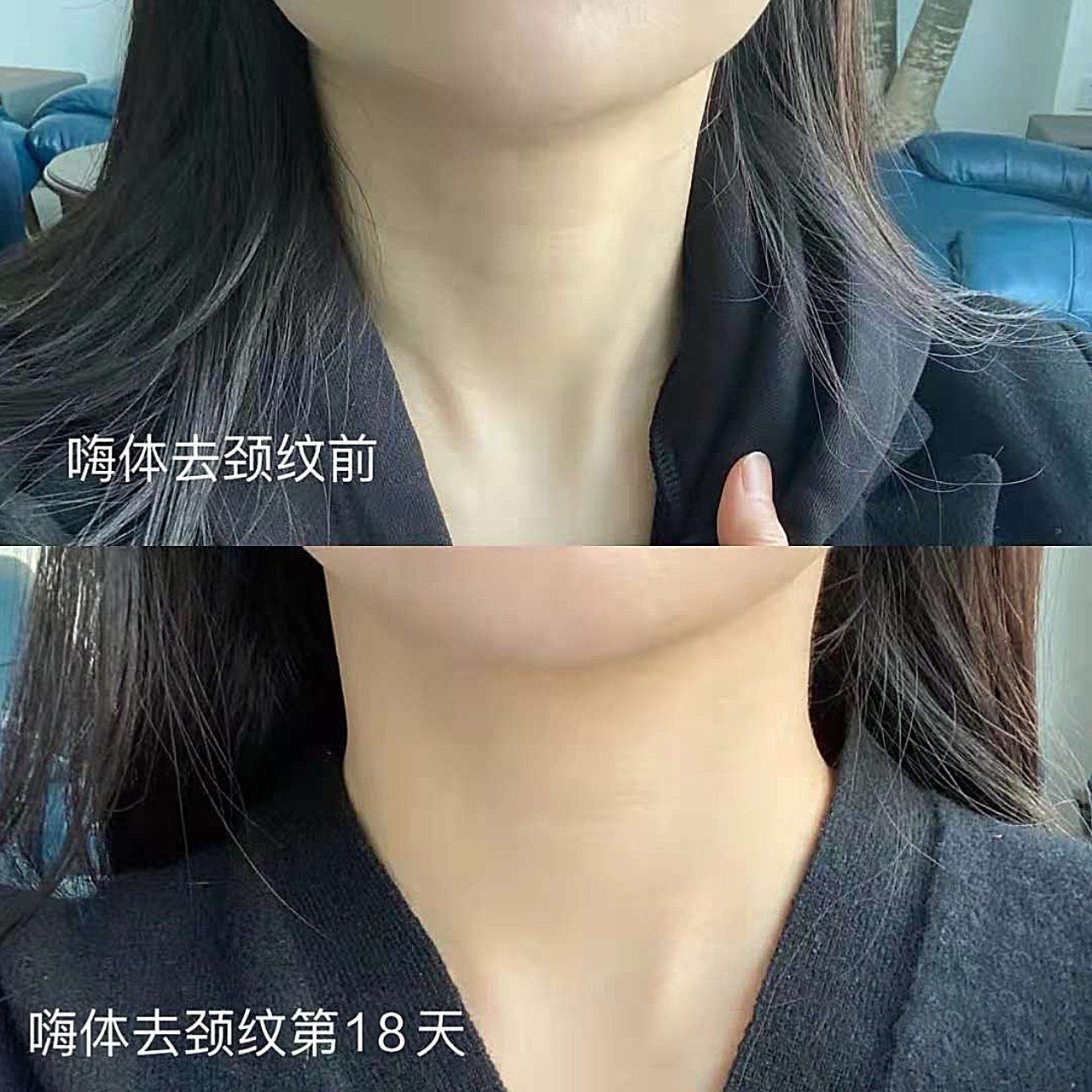 我的颈纹属于天生的颈纹,从小就有的那种,再