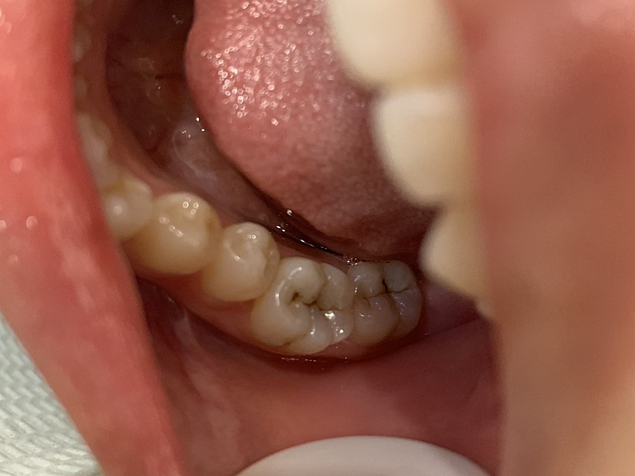 最近发现自己牙齿上有小黑点,就在在新氧咨询了在这家_圈子-新氧美容