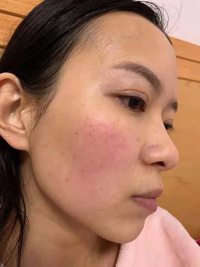 因为秋冬季干燥,面部泛红出现红血丝,我就自己敷了个_圈子-新氧美容