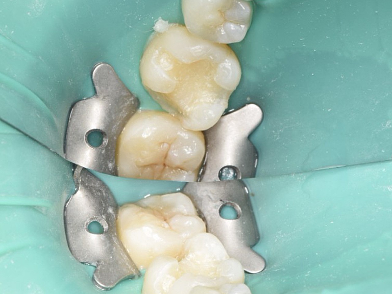 真的是我的一个心病,就来了离家近的植得口腔医院,补牙的贾医生很温柔