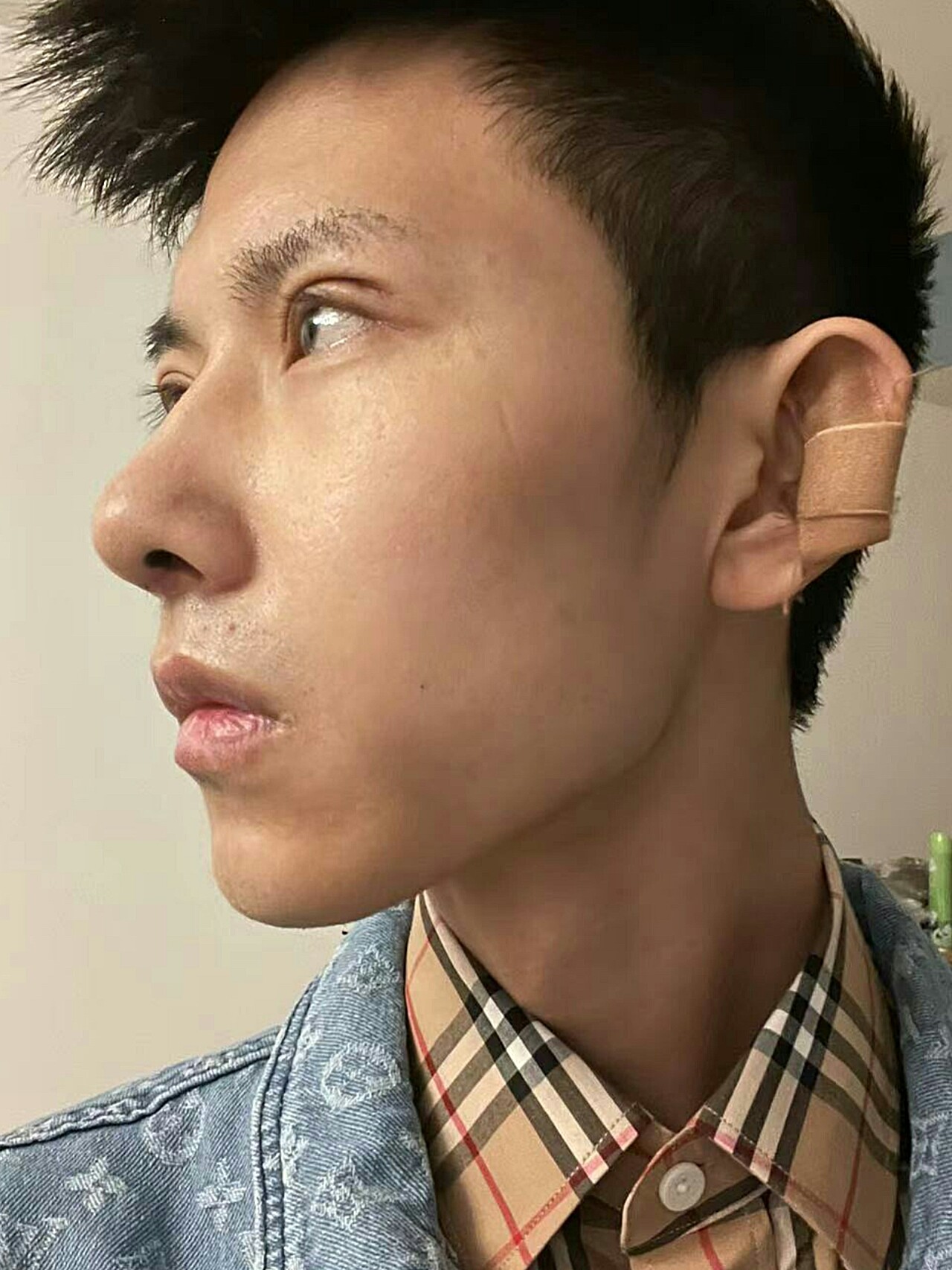 鼻头大,鼻小柱短;双眼皮形态差,无神