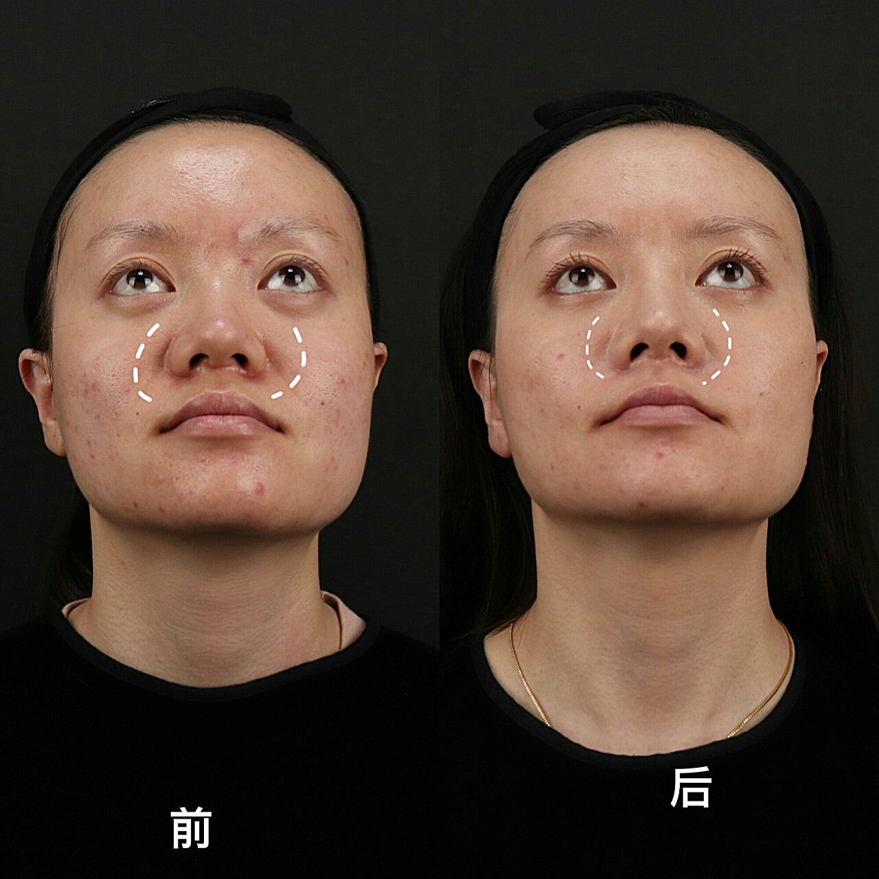 术前诊断面部凹陷方案设计乔雅登全脸填充手术总结这_圈子-新氧美容